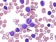 chronic-lymphocytic-leukemia-2