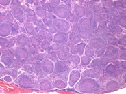 Follicular lymphoma 1 