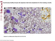 Hepatosplenic T-cell lymphoma appearing in the peripheral blood