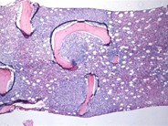 Follicular Lymphoma - 15.