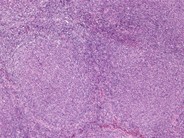 Follicular Lymphoma - 4.