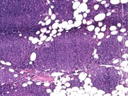 Follicular Lymphoma - 5.