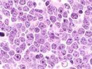 Burkitt Lymphoma - 3.