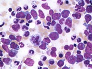 Burkitt Lymphoma - 6.