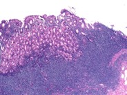 Gastric MALT Lymphoma - 3.