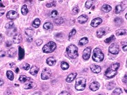 Diffuse Large Bcell Lymphoma 1.