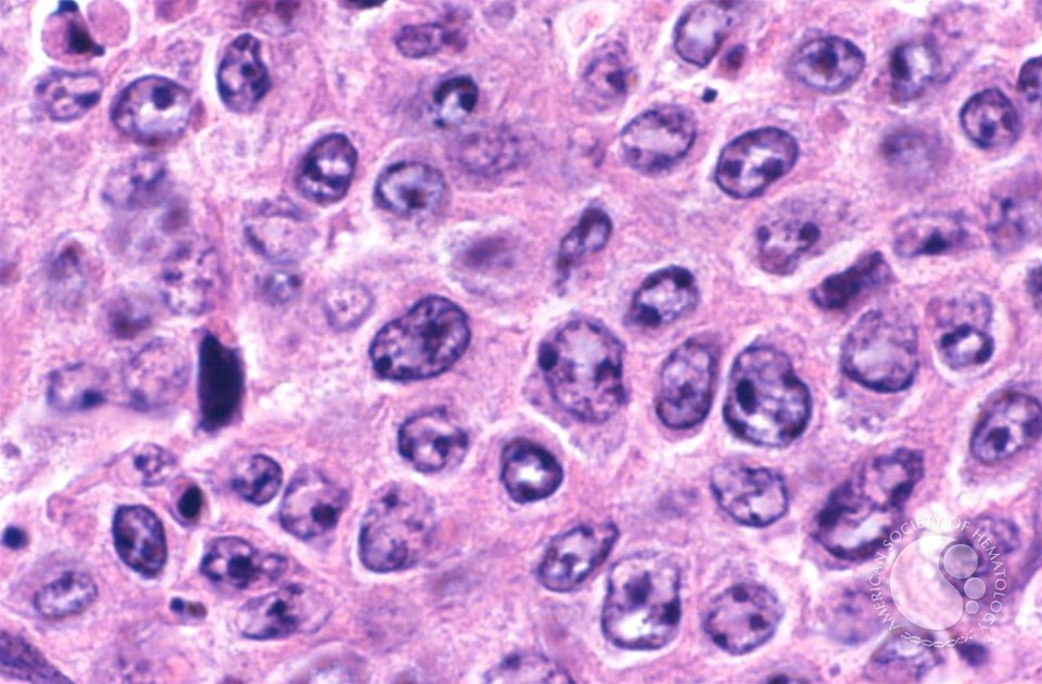 Diffuse Large B Cell Lymphoma 1
