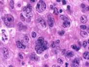 Diffuse Large B-cell Lymphoma - 2.