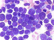 Acute Myeloid Leukemia with Maturation - 3.