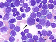 AML With Maturation - 6.