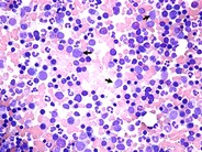 Relapsed Precursor B Cell Acute Lymphoblastic Leukemia - 1.