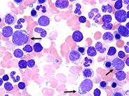 research paper on acute lymphocytic leukemia