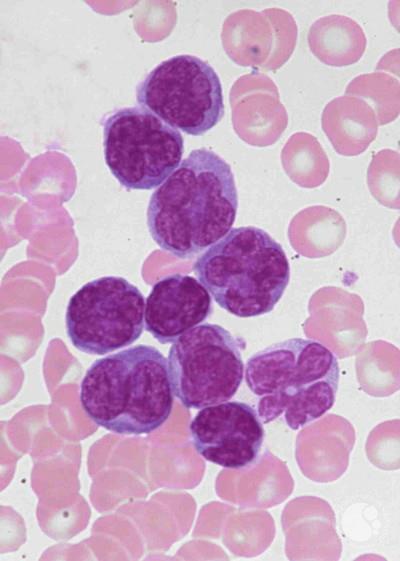 treatment cell skin lymphoma b T Cutaneous lymphoma adult leukemia cell treatment cell skin lymphoma b T Cutaneous lymphoma adult leukemia cell