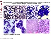 Plasma cell leukemia masquerading as carcinocythemia