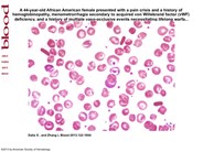 hemoglobin sc disease blood smear