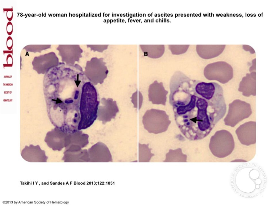 Killers on the road: Klebsiella and Pseudomonas bacteremia detected on peripheral blood smear