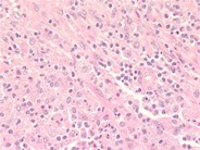 Histoplasmosis