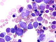 Acute Myeloid Leukemia with Multilineage Dysplasia - 1.