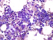 Acute Myeloid Leukemia with Multilineage Dysplasia - 2.
