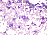 Acute Myeloid Leukemia with Multilineage Dysplasia - 3.