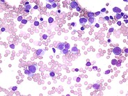 Acute Myeloid Leukemia with Multilineage Dysplasia - 3.