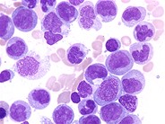 Chronic Myelomonocytic Leukemia - 2.