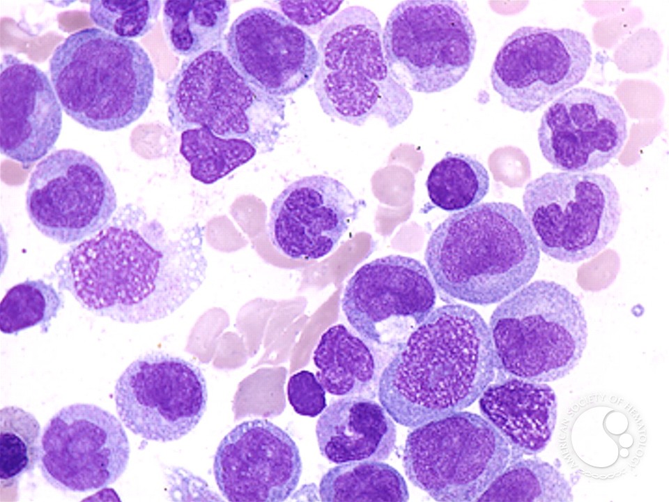 Chronic Myelomonocytic Leukemia - 2.