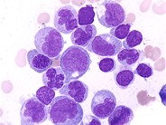 Chronic Myelomonocytic Leukemia - 3.