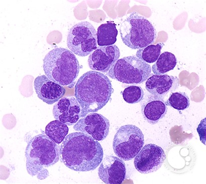Chronic Myelomonocytic Leukemia - 3.
