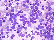 Acute Myeloid Leukemia without Maturation - 1.