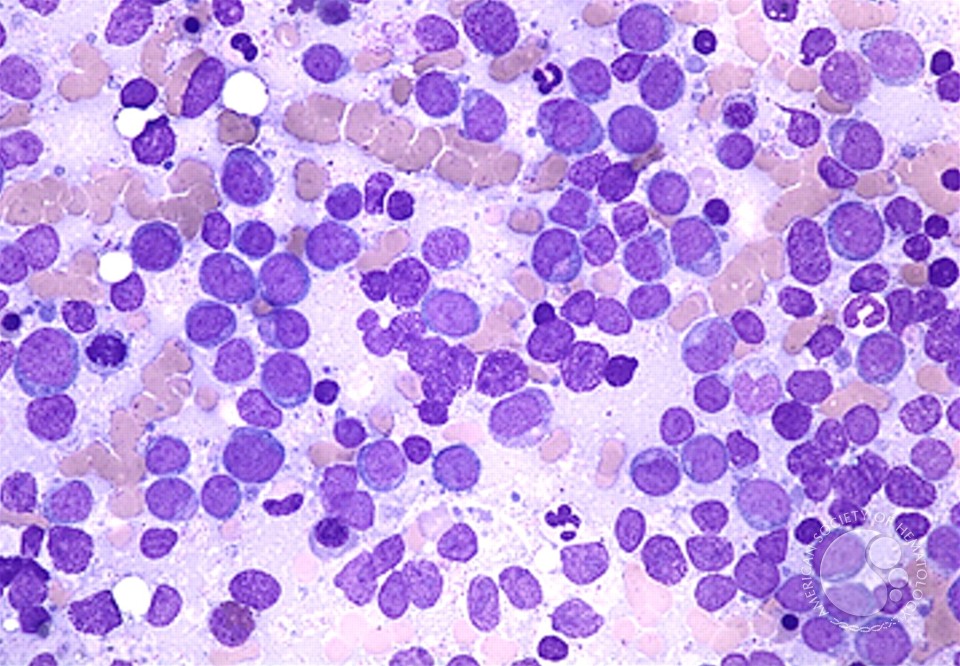 Acute Myeloid Leukemia without Maturation - 1.