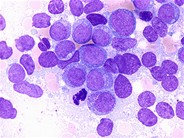 Acute Myeloid Leukemia without Maturation 3.