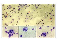 Hemophagocytosis in a Young Woman with a Recent Diagnosis of Adult Onset Still’s Disease