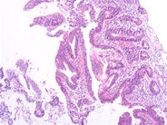 Eneropathy Associated T Cell Lymphoma - 1.