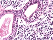 Gastric MALT Lymphoma - 1.