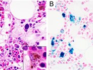 Macrophage iron accumulation in anemia of chronic inflammation