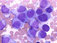 Acute Monocytic Leukemia - 1.