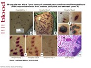 Cutaneous thrombosis in PNH