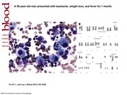 Hemophagocytosis and complex marrow karyotype in metastatic adenocarcinoma