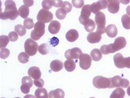 Plasmodium Vivax - 4.