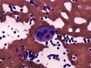 Dysplastic Megakaryocyte - 1.