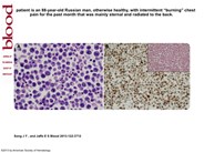 HHV-8–positive but EBV-negative primary effusion lymphoma