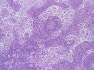 Sinus Histiocytosis With Massive Lymphadenopathy Rosai Dorfman Disease