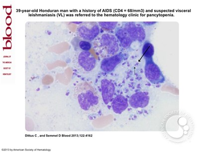 Leishmania amastigotes visualized on bone marrow aspirate in a leishmaniasis and HIV coinfected patient presenting with pancytopenia