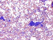 Metastatic Neuroblastoma - 2.