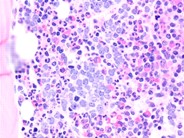 Metastatic Neuroblastoma 6