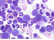 Accelerated Phase CML - 2.