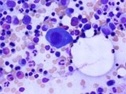 Multiple Myeloma - Large Plasma Cells - 3.