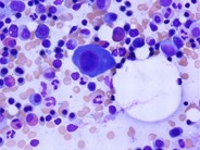 Multiple Myeloma - Large Plasma Cells - 3.