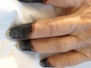 Finger necrosis in cold aglutinnin disease